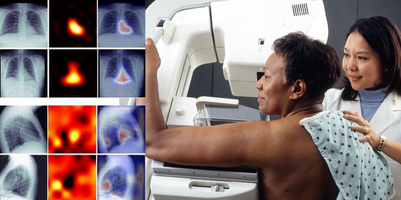 Des radiologues s'intéressent au deep learning pour diagnostiquer les calcifications coronaires