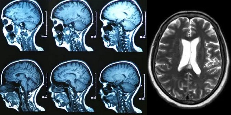 Un modèle de deep learning permet de classer avec précision six types de tumeurs intracrâniennes