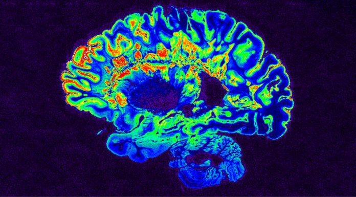 Diagnostiquer la sclérose en plaques grâce à l'intelligence artificielle