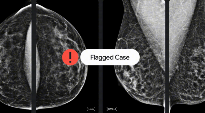 Google Health et iCAD partenaires pour la détection du cancer du sein