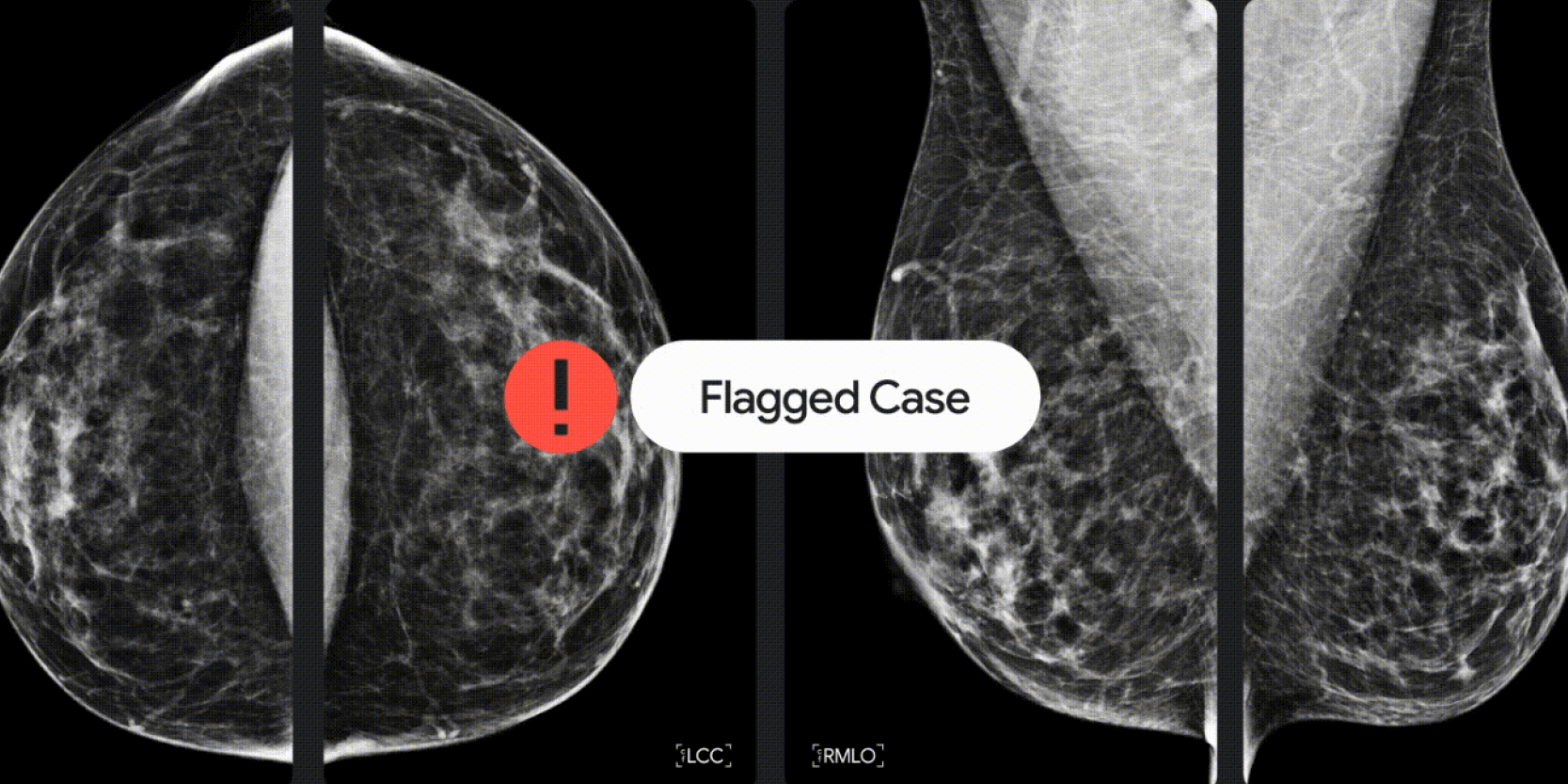 Google Health and iCAD partner to detect breast cancer