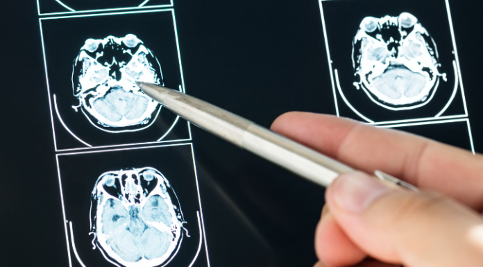 IA et oncologie : l’IUCT-Oncopole et l’IRT Saint Exupéry présentent les résultats de leurs premiers travaux pour lutter contre les tumeurs du cerveau